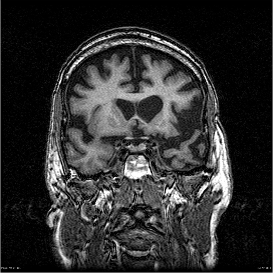 意味性認知症 MRI T1強調像 冠状断
