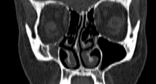 サイレント副鼻腔症候群 CT 冠状断