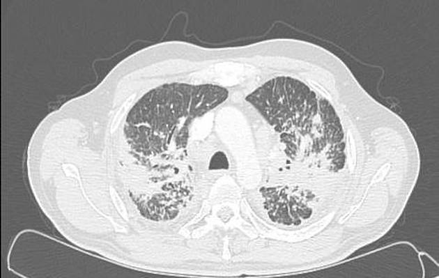珪肺 進行性塊状線維化 CT