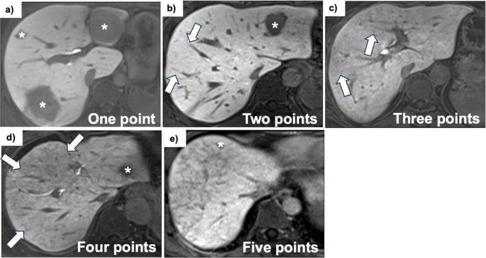 類洞閉塞症候群 EOB-MRI 肝細胞相 横断像