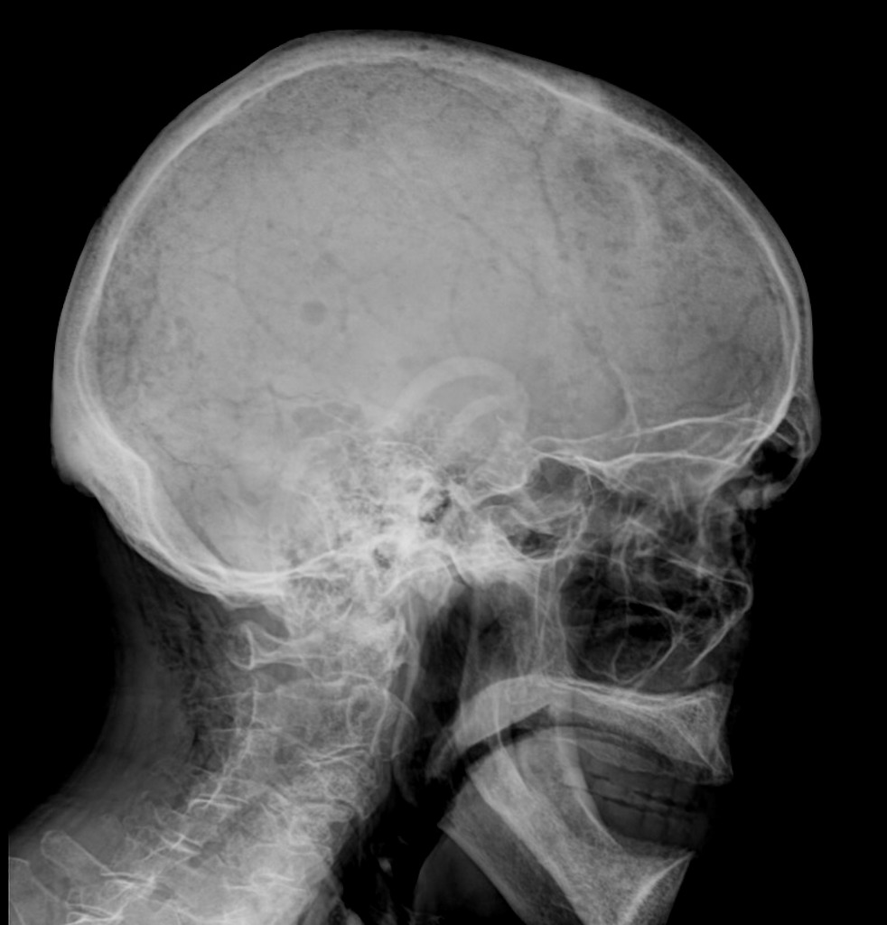 多発性骨髄腫の打ち抜き像(raindrop skull) 頭蓋単純X線 側面像