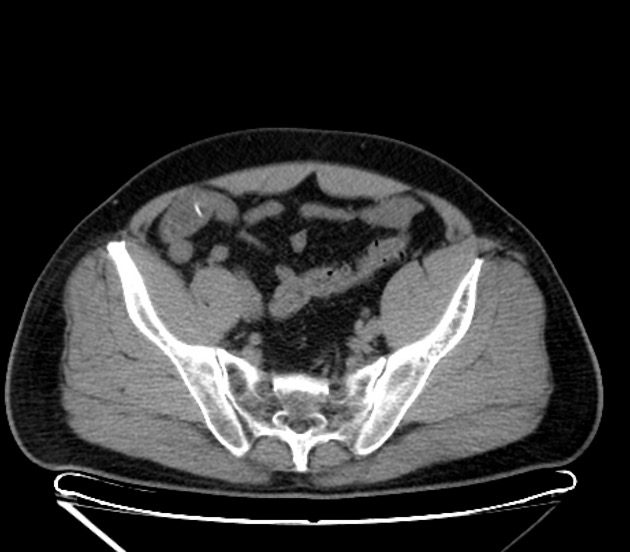 魚骨による小腸穿孔 CT