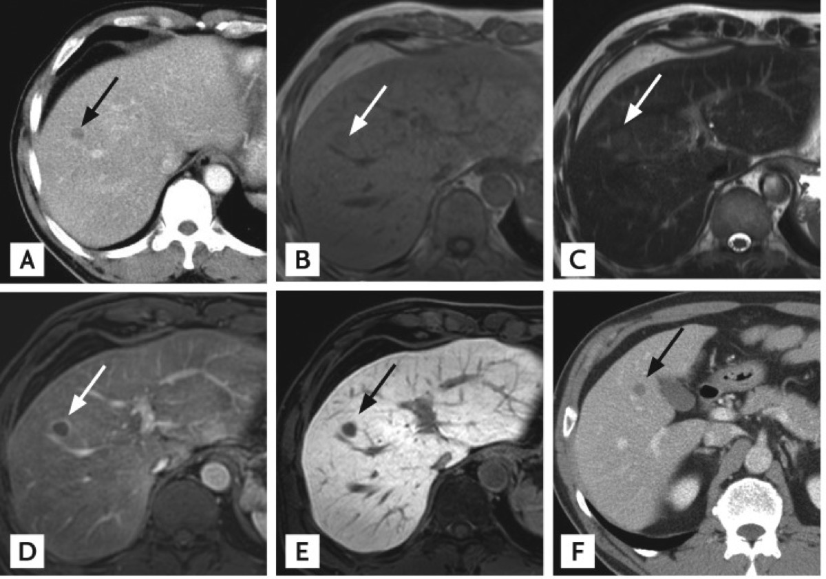 肝 孤立性壊死結節 CT MRI T1 T2 造影 経過