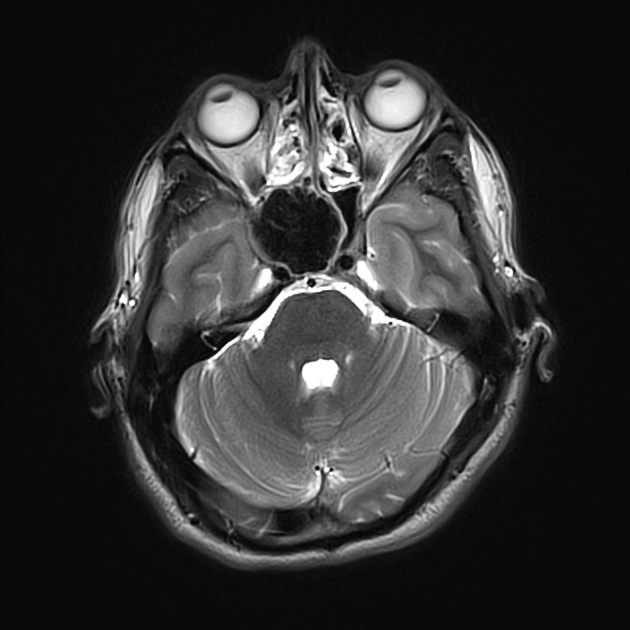 蝶形骨洞 真菌塊 MRI T2強調像