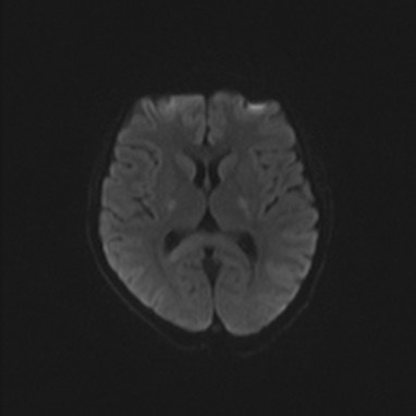 低血糖脳症 MRI 拡散強調像 横断像 内包後脚