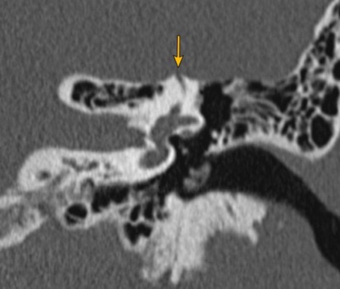 上半規管裂隙症候群 CT(側頭骨) 冠状断