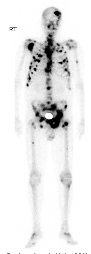 前立腺癌の多発骨転移 superscan 骨シンチ(Tc-99m MDP) 全身前面像