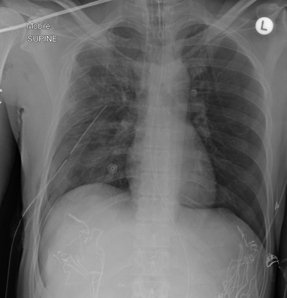 仰臥位胸部X線 気胸 deep sulcus sign