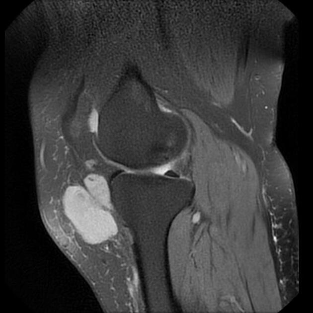 滑膜肉腫 MRI プロトン密度強調脂肪抑制像 矢状断像