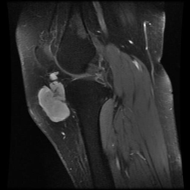 滑膜肉腫 MRI 造影T1強調脂肪抑制像 矢状断像