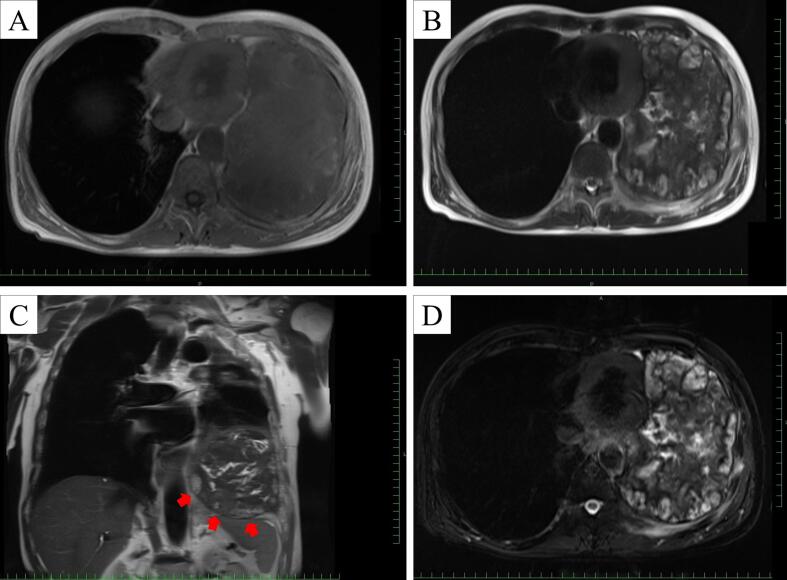 胸腔内慢性膨張型血腫 MRI