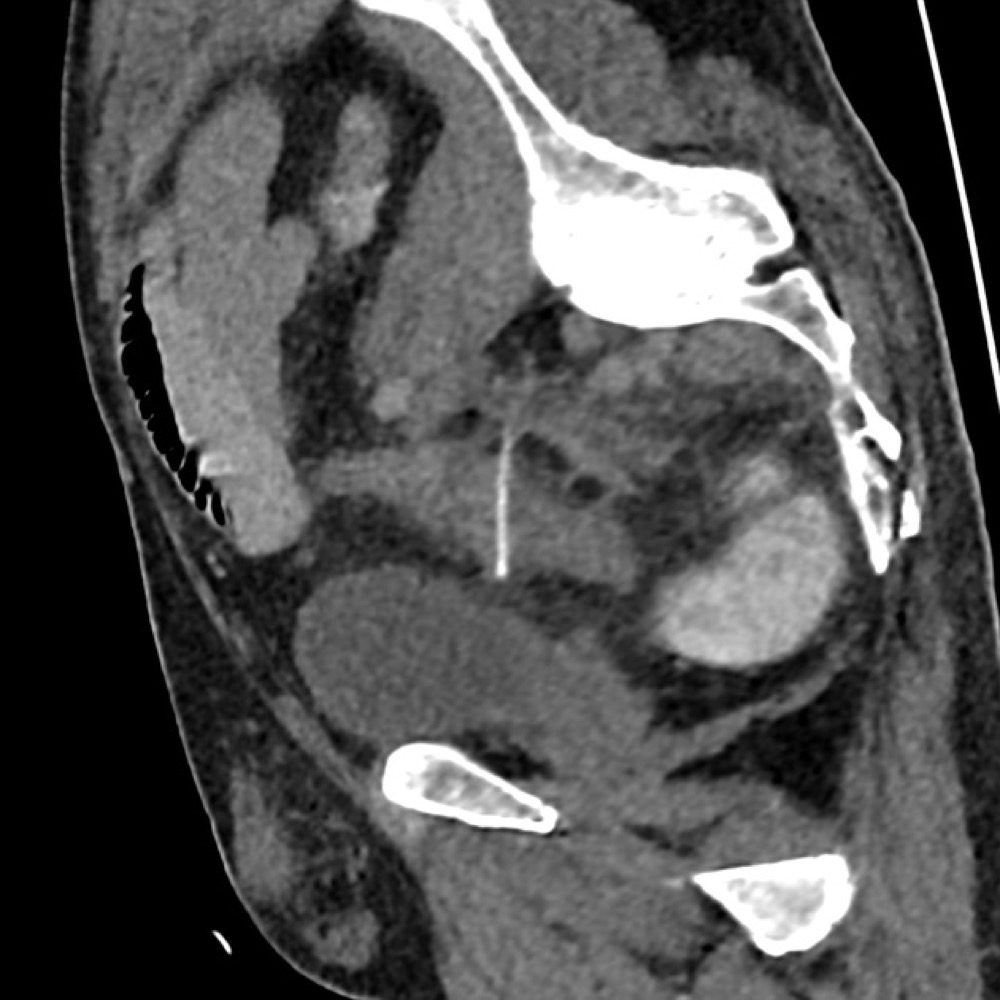 爪楊枝の誤飲によるS状結腸穿孔 CT 矢状断像