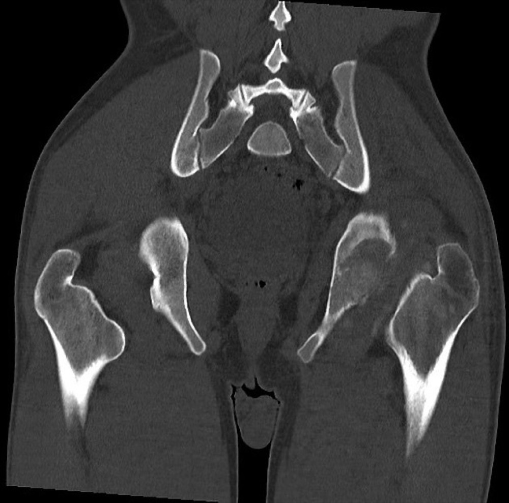 股関節の結核性関節炎 CT 骨条件 冠状断像