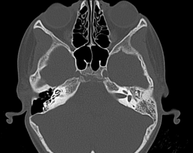 鼓室硬化症 側頭骨CT 横断像