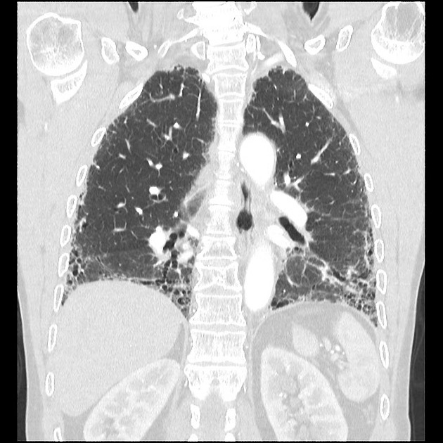 通常型間質性肺炎(UIP) CT 冠状断
