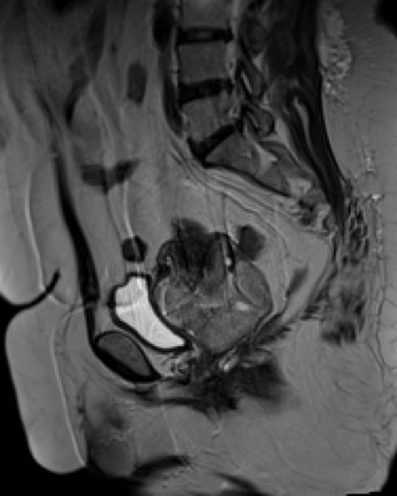 子宮癌肉腫 MRI T2強調像 矢状断像