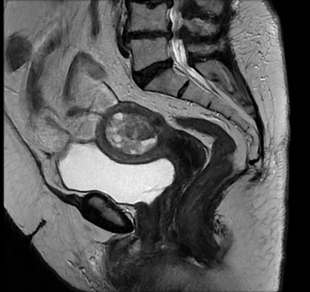 子宮腺肉腫 MRI T2強調像 矢状断像