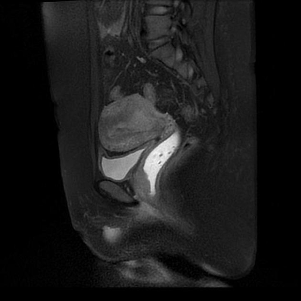 腟癌 MRI 脂肪抑制T2強調像 矢状断像