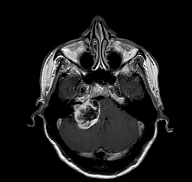 前庭神経鞘腫(聴神経腫瘍) MRI 造影T1強調像 横断像